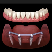 All-on-four style dentures attached to implants for strong, long-lasting tooth replacement.