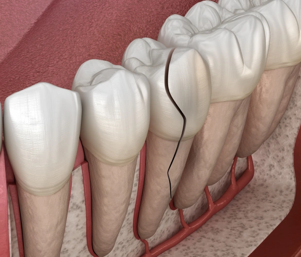 A dental diagram showing a significant vertical crack in a tooth.