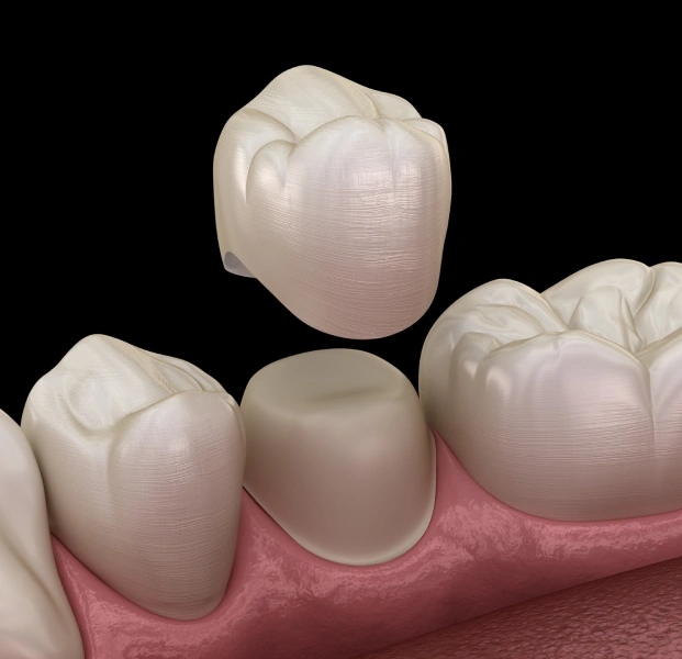 dental-crowns-alpharetta