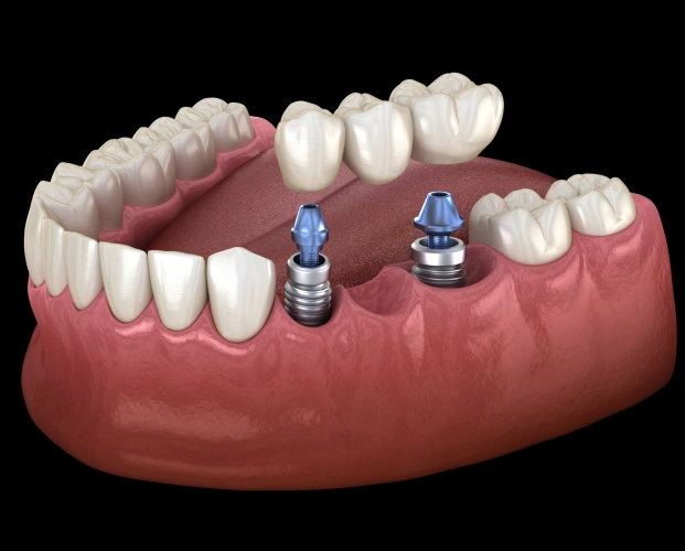 implant-crown-or-bridge-alpharetta