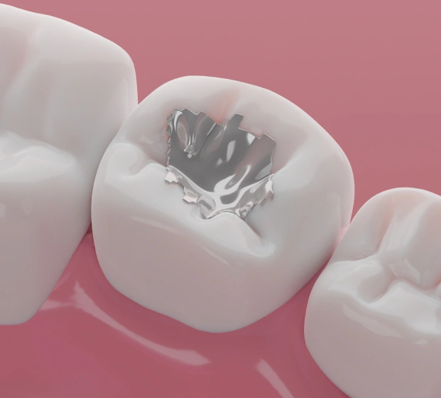 Detailed view of a traditional silver filling on a white tooth.