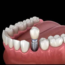 Illustration showing a single dental implant placed in the jaw to replace a missing tooth.