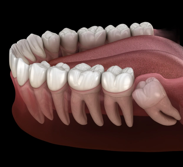 Medical illustration of an impacted wisdom tooth requiring professional removal in Alpharetta.