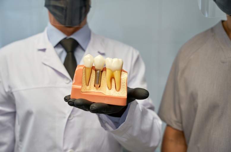 Dental implant model showing titanium post and crown for tooth replacement in Alpharetta dental clinic
